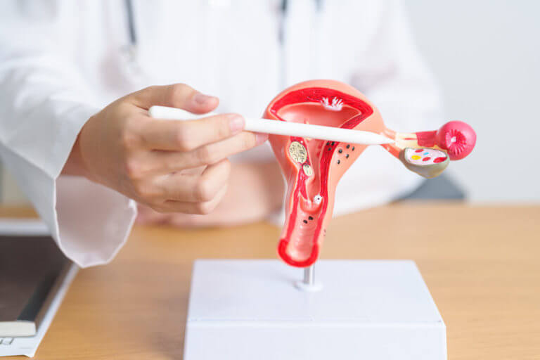 A gynecologist specializing in PCOS is holding a model of the uterus and ovaries.
