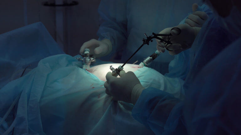 Image showing a surgical team operating with laparoscopic equipment used to treat endometriosis.